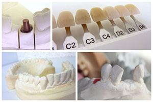 The image shows a collage of dental implants with numbered trays, displaying various stages of the implant process, including individual teeth and full sets arranged for presentation.