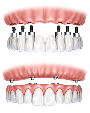 The image shows a set of dental implants with visible screws and pink gum-like structures, displayed against a white background.