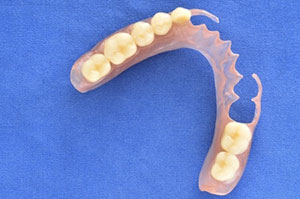 The image shows a partial denture with multiple teeth missing, placed against a blue background.