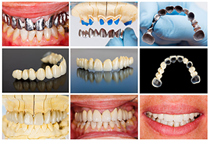 The image displays a collage of various stages of teeth whitening treatments, featuring before-and-after photos with different levels of tooth discoloration and corresponding results after treatment.